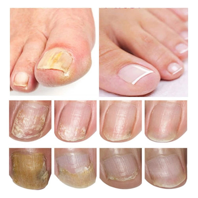 Reparador para Tratamento de Micose de Unha / Fungo