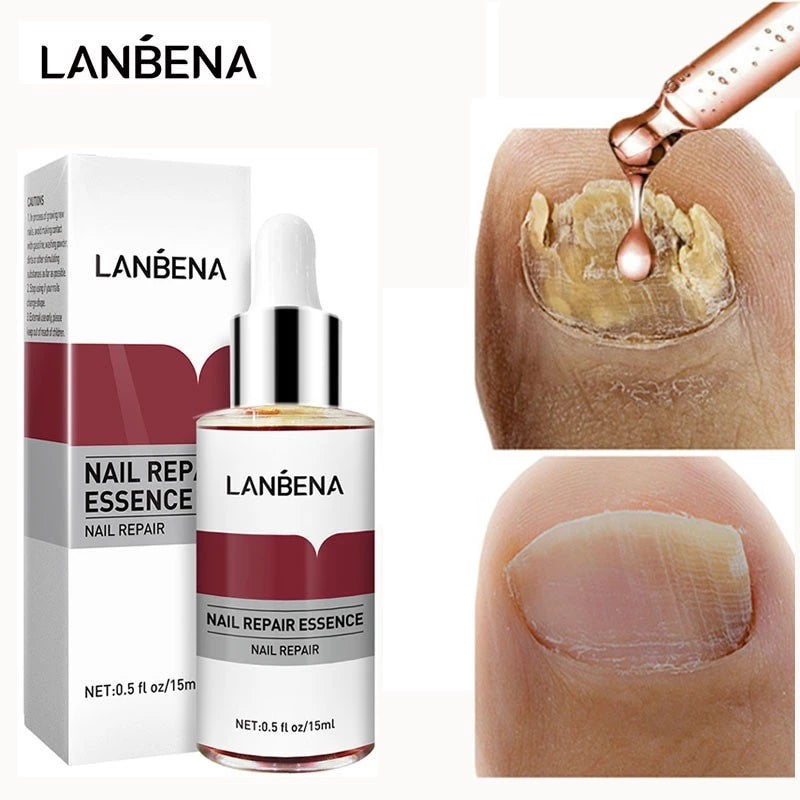 Reparador para Tratamento de Micose de Unha / Fungo